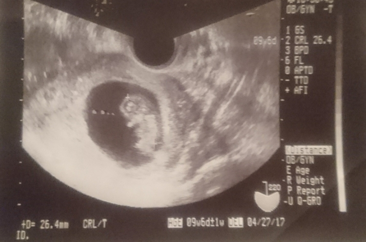妊娠12週前後 赤ちゃんの首の後ろの浮腫 Nt と胎児ドック しのくろ育児録